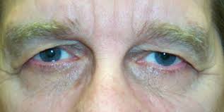 Brow ptoza